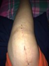 [Bonesmart.org] I just got my new knee.