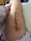 [Bonesmart.org] I just got my new knee.