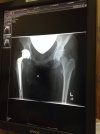 [Bonesmart.org] teenager hip replacement after SUFE