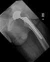 [Bonesmart.org] Bill's Bionic Breakdown
