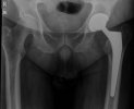 [Bonesmart.org] Bill's Bionic Breakdown