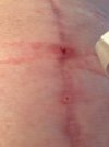 [Bonesmart.org] I just got my new knee.