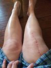 [Bonesmart.org] I just got my new knee.