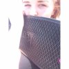 [Bonesmart.org] teenager hip replacement after SUFE