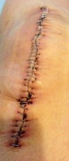 [Bonesmart.org] Nana Moon's Shiny New Second Knee