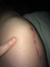 [Bonesmart.org] I just got my new knee.