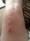 [Bonesmart.org] CATSMUM's new road to recovery