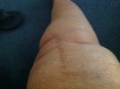 [Bonesmart.org] One Good Leg.