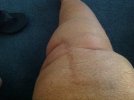 [Bonesmart.org] One Good Leg.