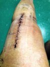 [Bonesmart.org] Rob's Knew Knee