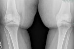 [Bonesmart.org] Looking for OS in Florida Who Will Operate on Obese Patients