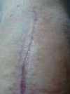 [Bonesmart.org] CATSMUM's new road to recovery