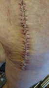 [Bonesmart.org] Not old yet but getting right hip done.