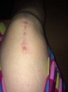 [Bonesmart.org] I just got my new knee.