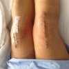 [Bonesmart.org] Birdy's Recovery Thread