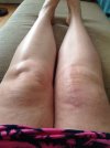 [Bonesmart.org] Raffs' Recovery Thread<'
