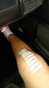 [Bonesmart.org] 1 week post TKR I'm hurting!! *