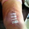 [Bonesmart.org] christeen's knee journey 8/11