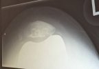 [Bonesmart.org] Christine's Post Op Recovery