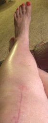 [Bonesmart.org] Kate's Knee Knews
