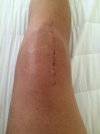 [Bonesmart.org] The Odyssey of My Newfangled Knee