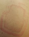[Bonesmart.org] Story of My Knees by RestAssured: Pt 3