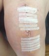 [Bonesmart.org] New knee for me !