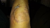 [Bonesmart.org] ironclm's recovery