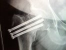 [Bonesmart.org] THR Follows Unsuccessful ORIF - Keeping Fingers Crossed