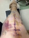 [Bonesmart.org] Timetolive's Nov 9th TKR Post -OP<<