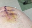 [Bonesmart.org] Timetolive's Nov 9th TKR Post -OP<<