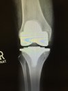 [Bonesmart.org] 1 Week post op