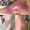 [Bonesmart.org] Timetolive's Nov 9th TKR Post -OP<<