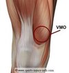 [Bonesmart.org] Now two years post op and still recovering from nerve damage