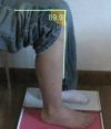 [Bonesmart.org] Gale- RTKR Oct 5th-Feeling Lost-13 days post op