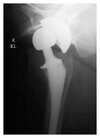 [Bonesmart.org] Post-op. Now at home.