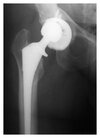 [Bonesmart.org] Post-op. Now at home.