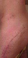 [Bonesmart.org] Post-op. Now at home.
