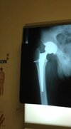 [Bonesmart.org] Post-op. Now at home.