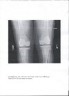 [Bonesmart.org] Chugging Down the Track to Recovery