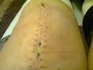 [Bonesmart.org] Onwards and upwards - my journey continues