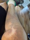 [Bonesmart.org] Timetolive's Nov 9th TKR Post -OP<<