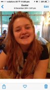 [Bonesmart.org] teenager hip replacement after SUFE