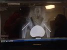 [Bonesmart.org] teenager hip replacement after SUFE