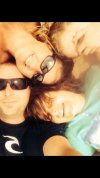 [Bonesmart.org] teenager hip replacement after SUFE
