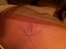 [Bonesmart.org] Déjà Vu: Squirrellymom's Right THR & Her Left THR