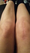 [Bonesmart.org] Post op RTKR