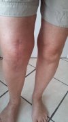[Bonesmart.org] Post op RTKR