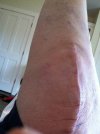 [Bonesmart.org] Unknown lump on front of knee'