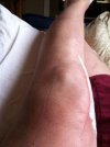 [Bonesmart.org] Unknown lump on front of knee'